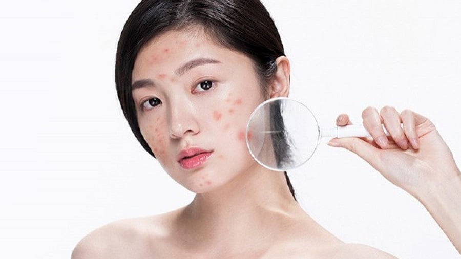 Người cầm kính lúp trước mặt, da có nhiều nốt mụn đỏ, nền trắng.