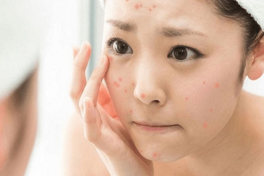 Người đang kiểm tra da mặt với nhiều nốt mụn đỏ, có vẻ lo lắng, trong bối cảnh phòng tắm.