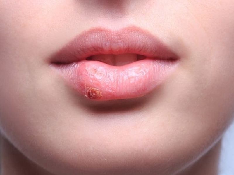 Đôi môi với vết loét nhỏ ở môi dưới, da môi khô và nứt nẻ.