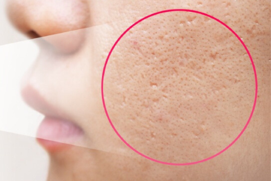 Cận cảnh làn da với lỗ chân lông to, được khoanh tròn để nhấn mạnh chi tiết.