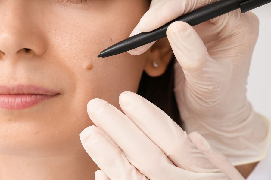 Bác sĩ đeo găng tay kiểm tra nốt ruồi trên mặt bệnh nhân bằng bút chỉ, trong môi trường y tế.
