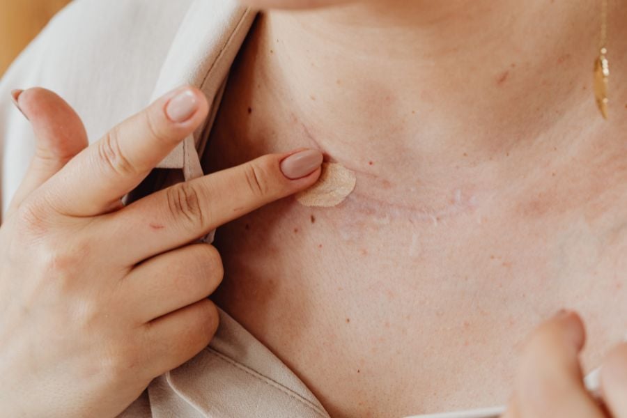Người đang chạm vào vết sẹo ở cổ với một miếng băng cá nhân màu be.