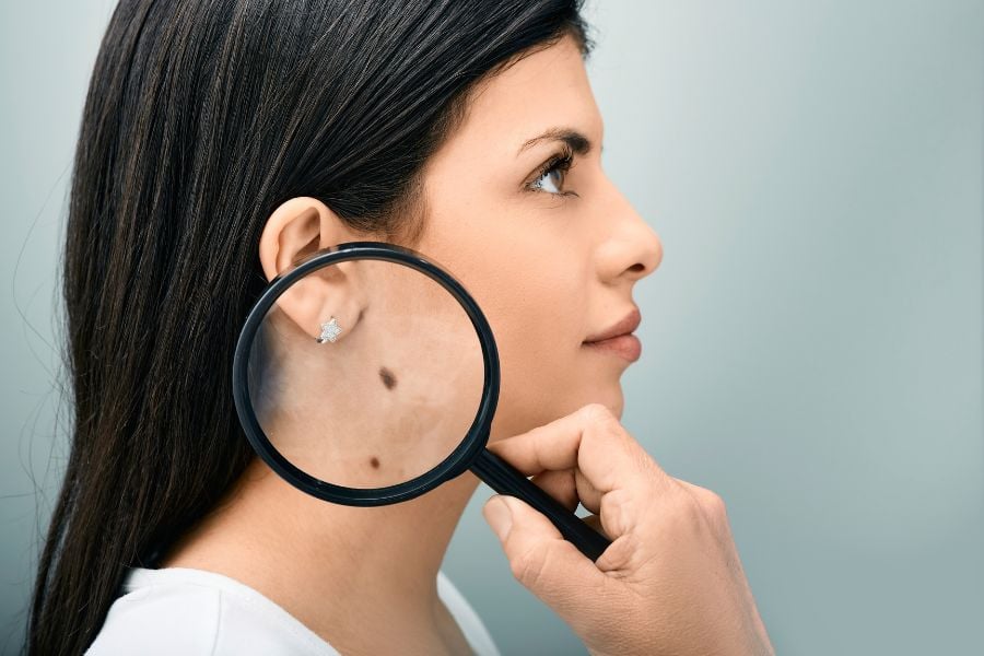 Người phụ nữ cầm kính lúp phóng to vùng da có nốt ruồi trên cổ, nền màu xanh nhạt.