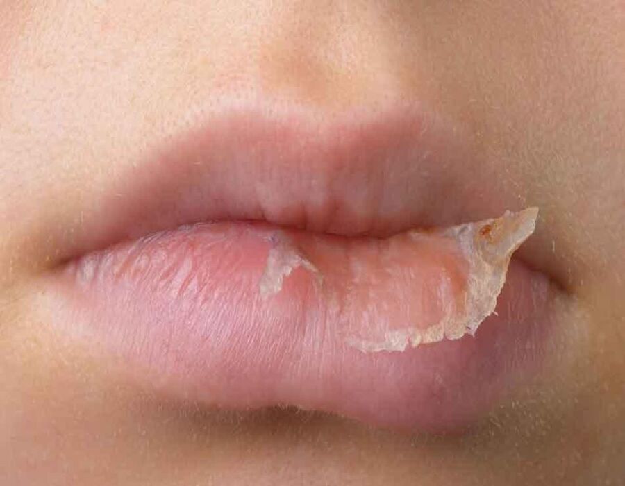 Đôi môi khô nứt nẻ với một mảng da bong tróc ở góc miệng.