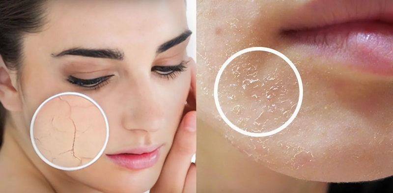 Khuôn mặt với vùng da khô, nứt nẻ được phóng to trong hình tròn bên cạnh môi.