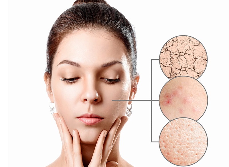 Người phụ nữ chạm mặt, bên cạnh là hình ảnh phóng to của các vấn đề da: khô, mụn, lỗ chân lông to.