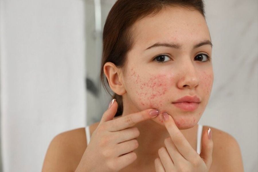 Người phụ nữ chạm vào khuôn mặt có mụn đỏ, biểu hiện quan tâm và tập trung.