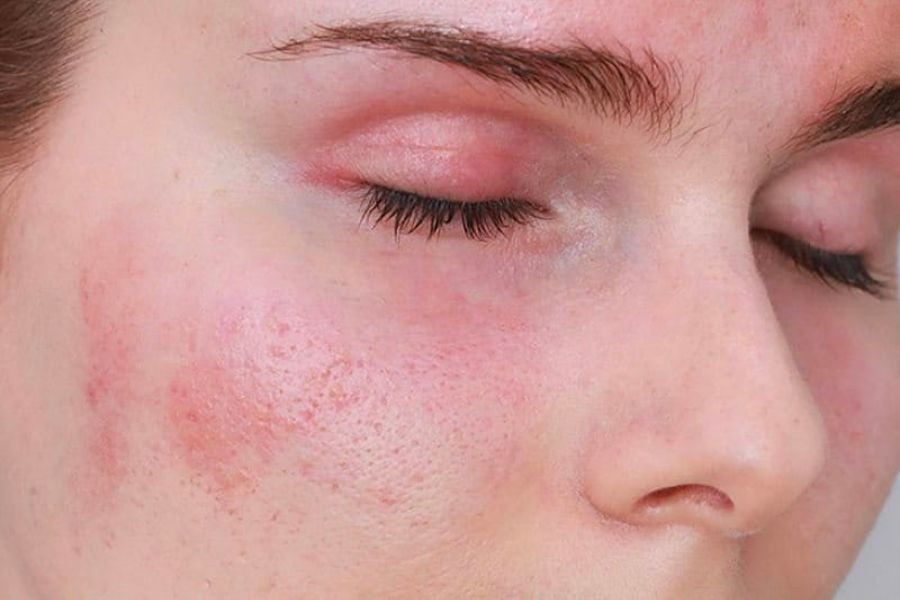 Khuôn mặt với làn da bị mẩn đỏ và mắt nhắm, cho thấy tình trạng kích ứng da.