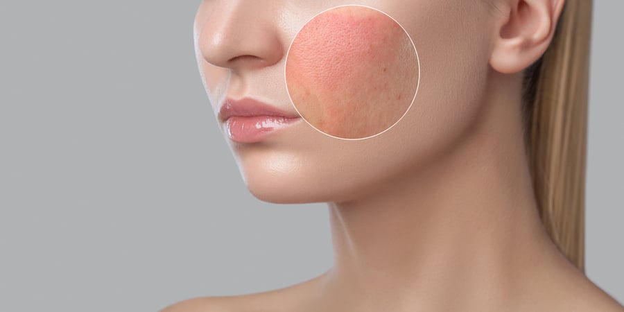 Cận cảnh mặt bên của một người với vùng da đỏ trên má được phóng to trong vòng tròn.