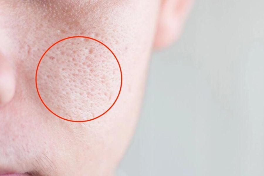 Cận cảnh da mặt với lỗ chân lông to, được khoanh tròn màu đỏ để làm nổi bật chi tiết.