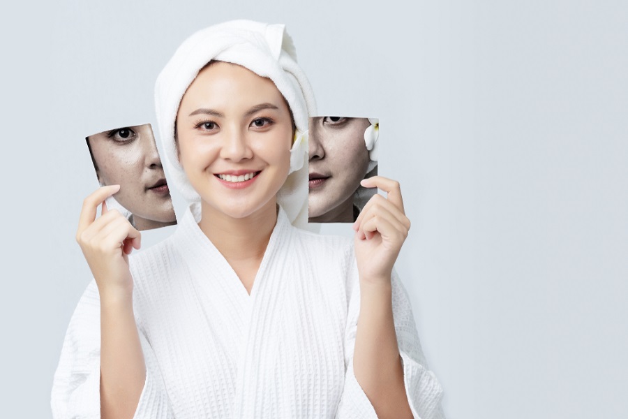 Người phụ nữ mặc áo choàng trắng, cầm hai bức ảnh khuôn mặt, một bên da mịn màng, một bên có vết nám.