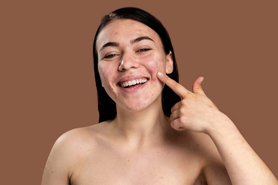 Người đang mỉm cười và chỉ vào má, trên nền màu nâu, làn da có một số vết mụn.