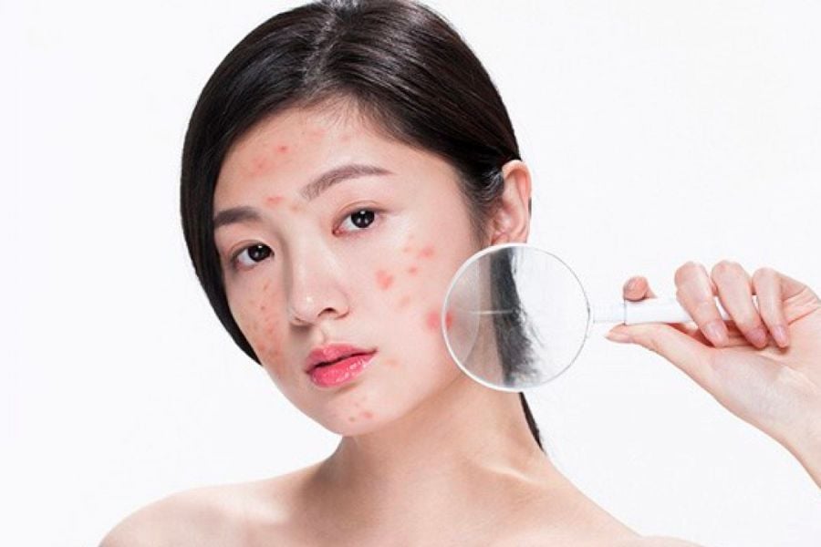 Kem chống nắng cho tuổi 14 M.O.I Cosmetics giải đáp 2 1 dac diem lan da tuoi 14 86ecdb429084468eb1aaa1971123ae7e 1