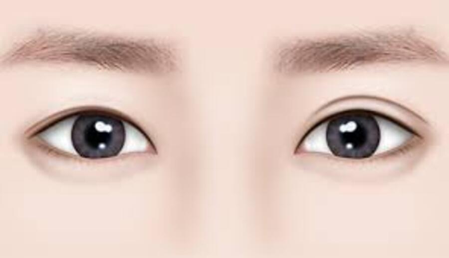 cach-khac-phuc-mi-mat-khong-deu-1_5ee5825328704b079f88486f3c595fae Mí mắt không đều là gì